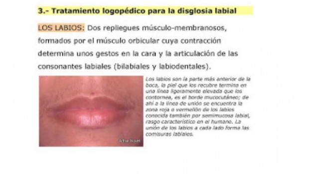 disglosia labial