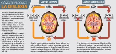 como se produce la dislexia infografia